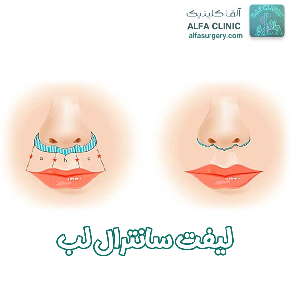 لیفت سانترال لب - مرکز جراحی آلفا