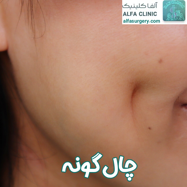 جراحی چال گونه - مرکز جراحی آلفا