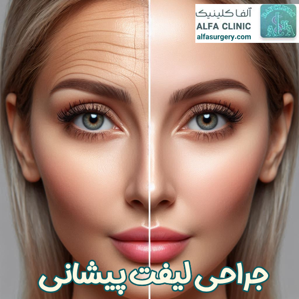 جراحی لیفت پیشانی - کلینیک جراحی آلفا