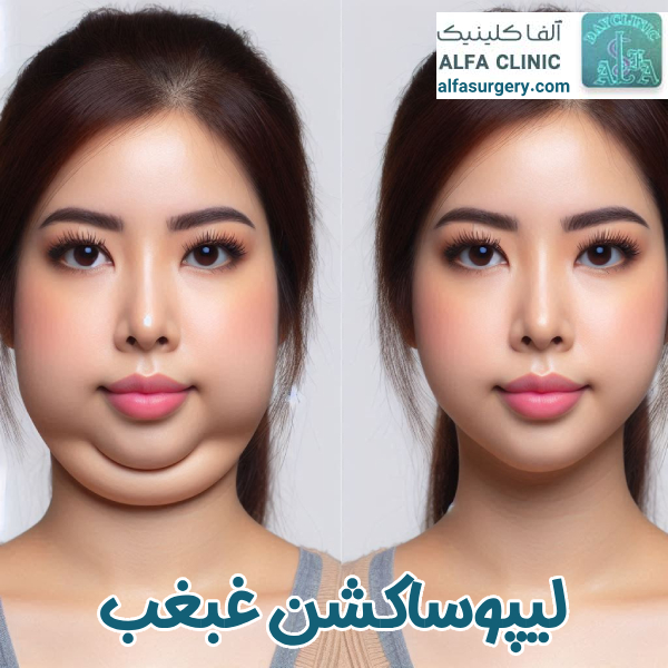 ساکشن غبغب | مرکز جراحی آلفا