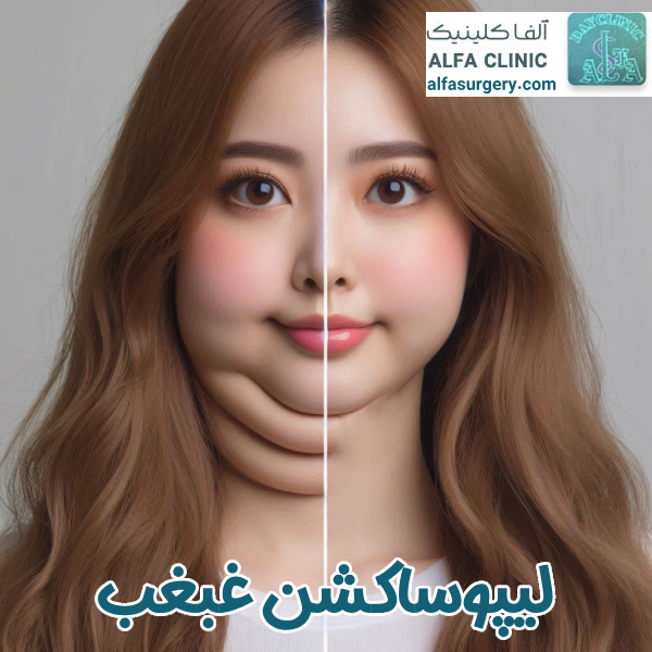 ساکشن غبغب | مرکز جراحی آلفا