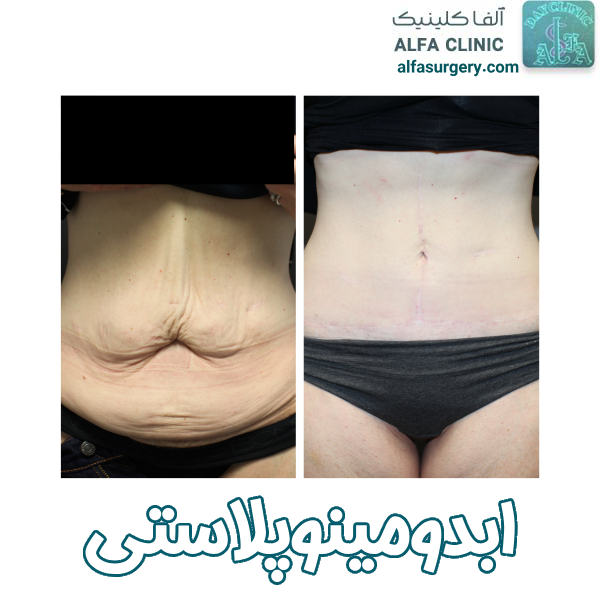 جراحی زیبایی شکم - مرکز جراحی آلفا