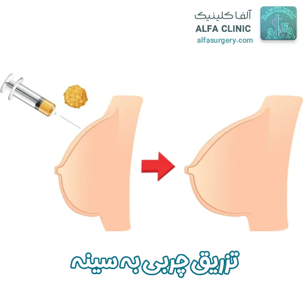 تزریق چربی به سینه - مرکز جراحی آلفا