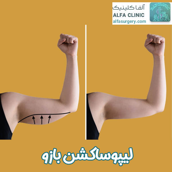 لیپوساکشن بازو - مرکز جراحی آلفا