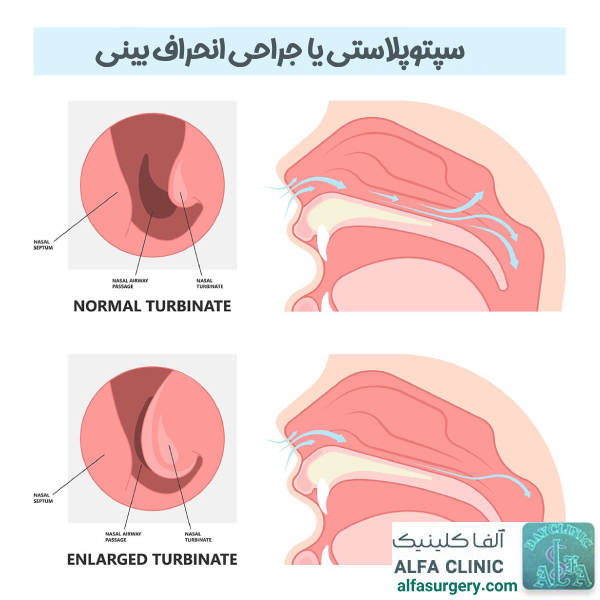 جراحی انحراف بینی - مرکز جراحی آلقا