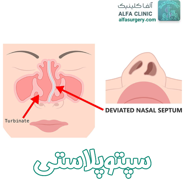 سپتوپلاستی - مرکز جراحی آلفا