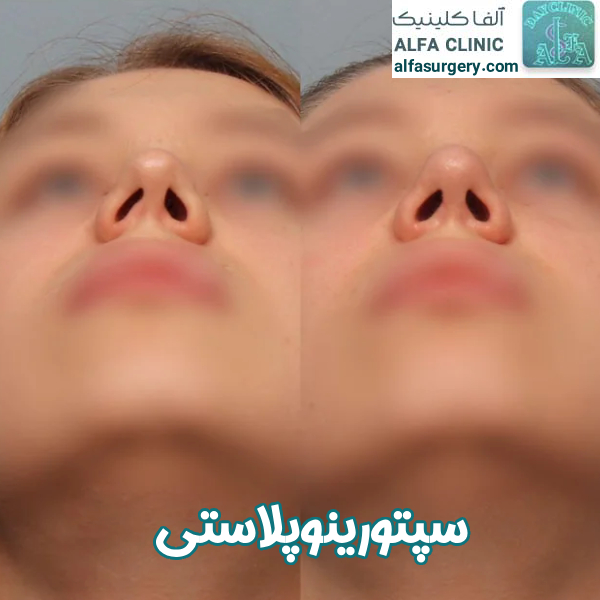 سپتورینوپلاستی - مرکز جراحی آلفا