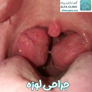 عمل برداشتن لوزه - مرکز جراحی آلفا