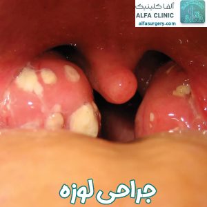 عمل لوزه - مرکز جراحی آلفا