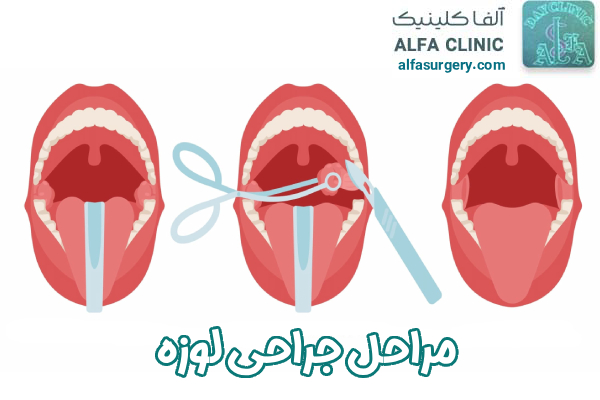 مراحل جراحی لوزه - مرکز جراحی الفا