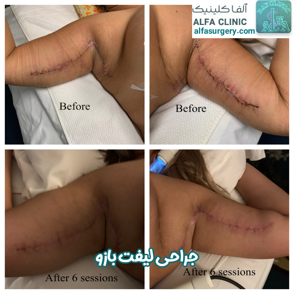 جراحی لیفت بازو - مرکز جراحی آلفا