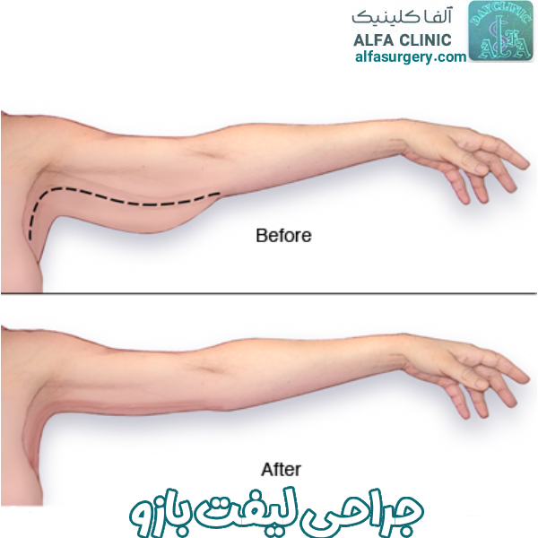 جراحی لیفت بازو - مرکز جراحی آلفا