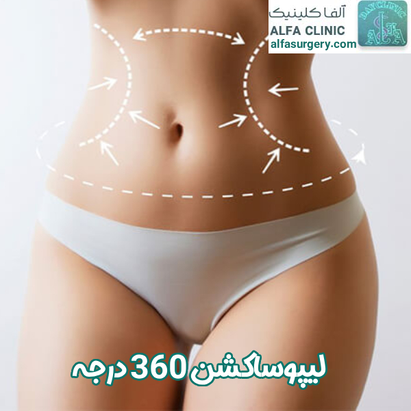 لیپوساکشن 360 درجه  - مرکز جراحی آلفا