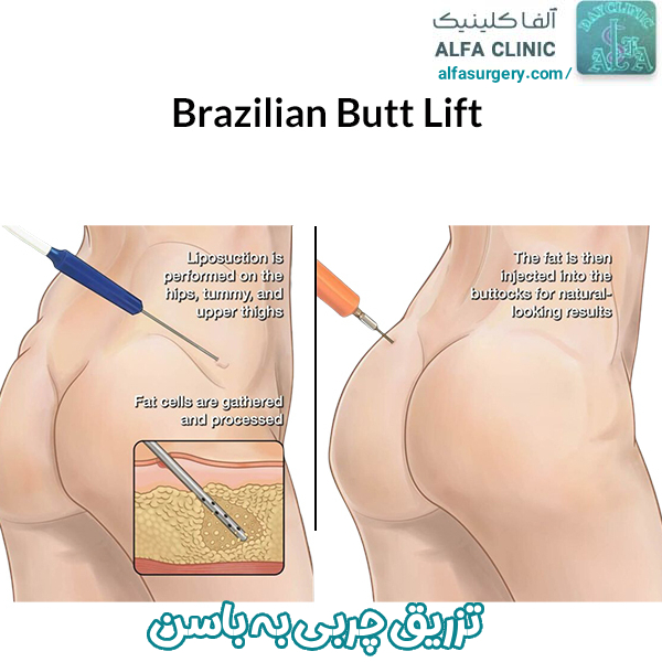 تزریق چربی به باسن - مرکز جراحی آلفا