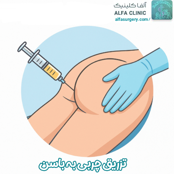 تزریق چربی به باسن - مرکز جراحی آلفا