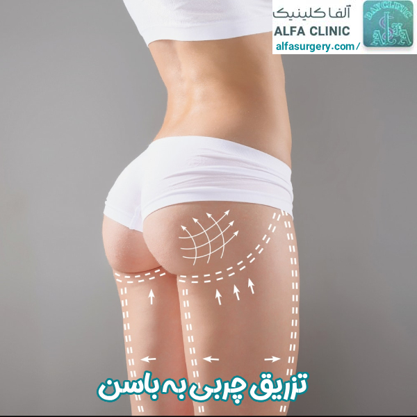 تزریق چربی به باسن - مرکز جراحی آلفا
