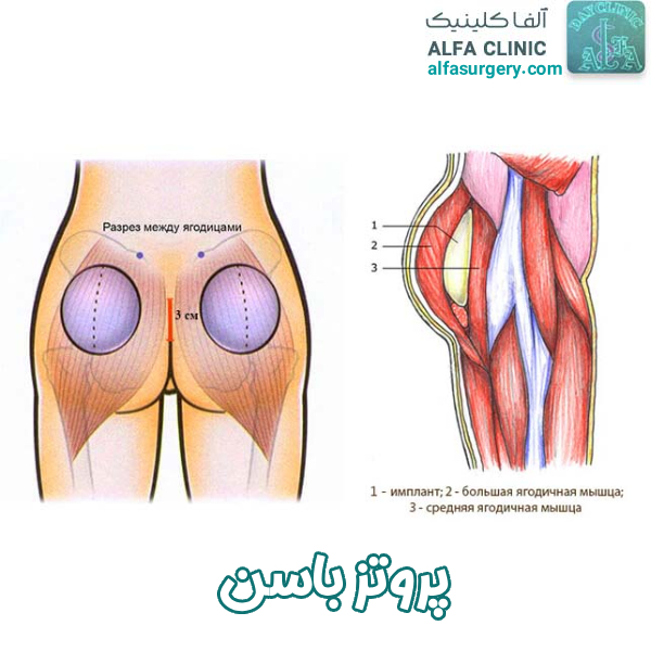 پروتز باسن - مرکز جراحی آلفا