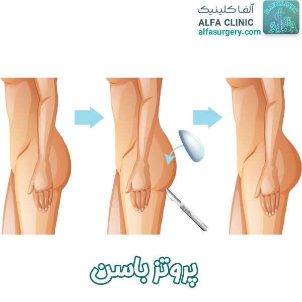 پروتز باسن - مرکز جراحی آلفا