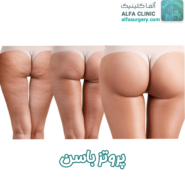 پروتز باسن - مرکز جراحی آلفا