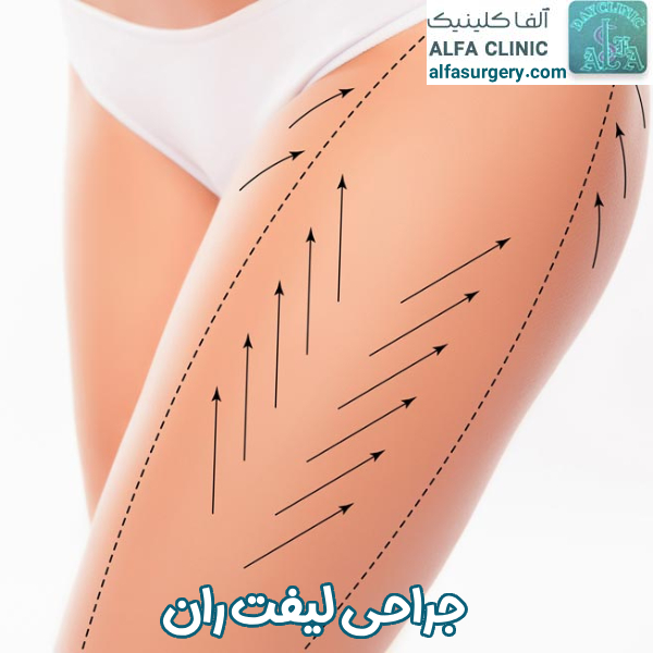 لیفت ران - مرکز جراحی آلفا