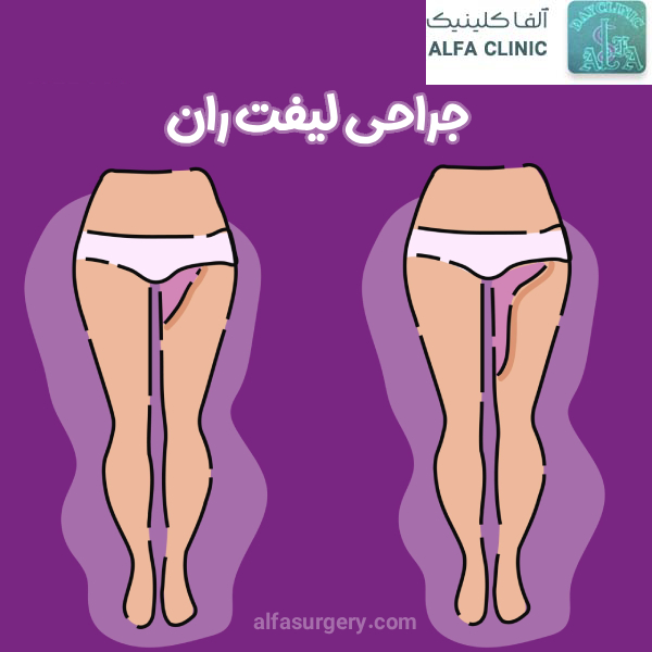 جراحی لیفت ران - مرکز جراحی آلفا