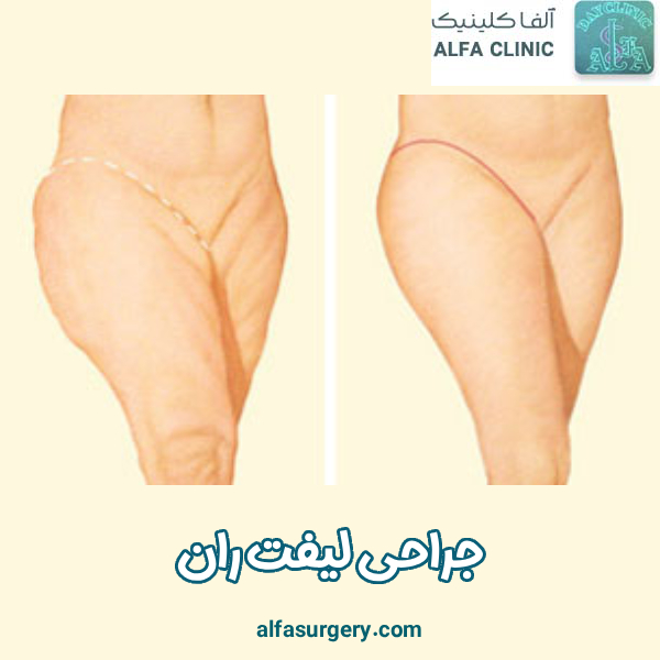 جراحی لیفت ران - مرکز جراحی آلفا