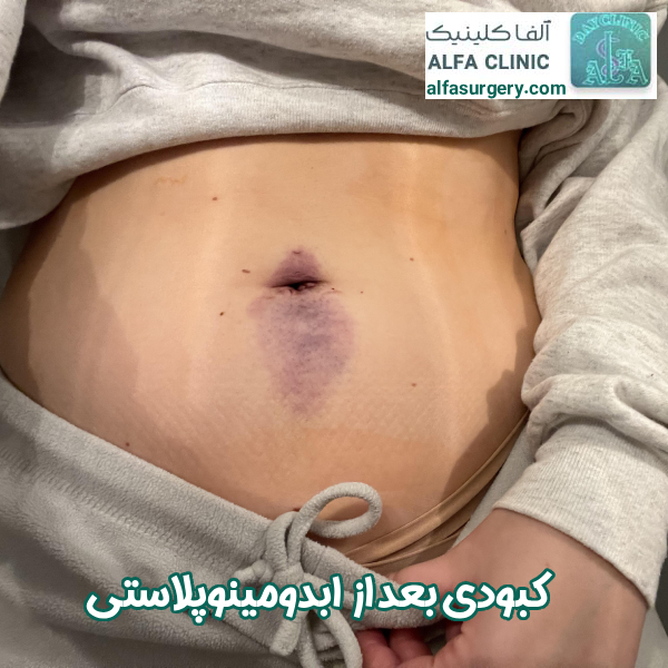 کبودی بعد از ابدومینوپلاستی - مرکز جراحی آلفا