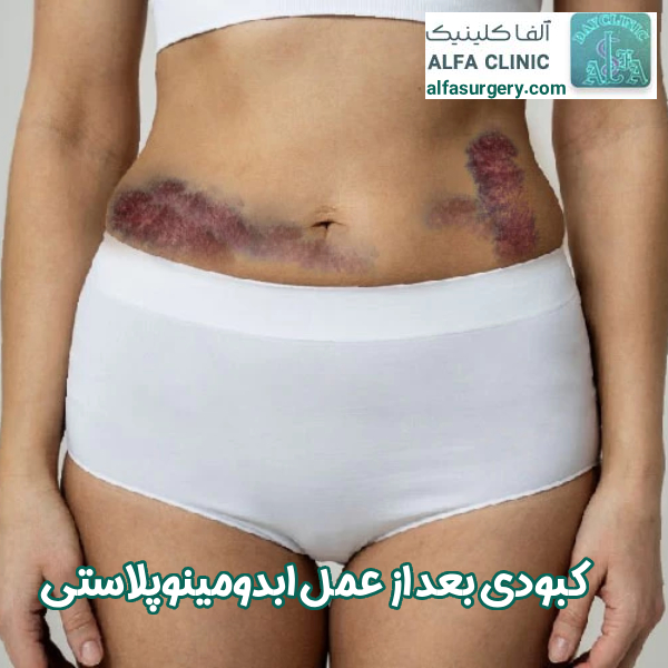 کبودی بعد از جراحی ابدومینوپلاستی - مرکز جراحی آلفا