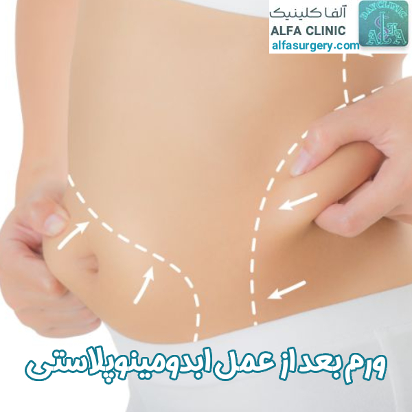 ورم بعد از ابدومینوپلاستی - مرکز جراحی آلفا