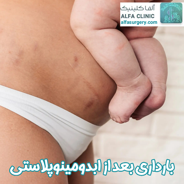 بارداری بعد از ابدومینوپلاستی - مرکز جراحی آلفا