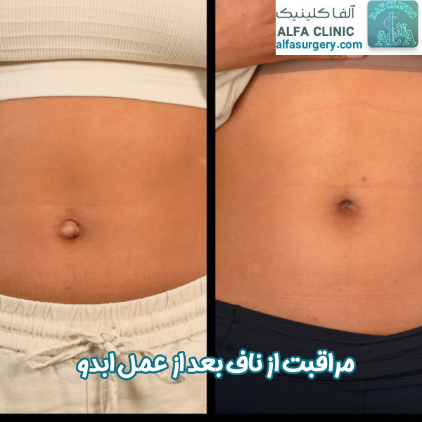 مراقبت از ناف بعد از ابدومینوپلاستی - مرکز جراحی آلفا