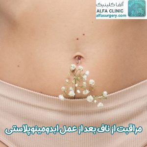 مراقبت از ناف بعد از ابدومینوپلاستی - مرکز جراحی آلفا