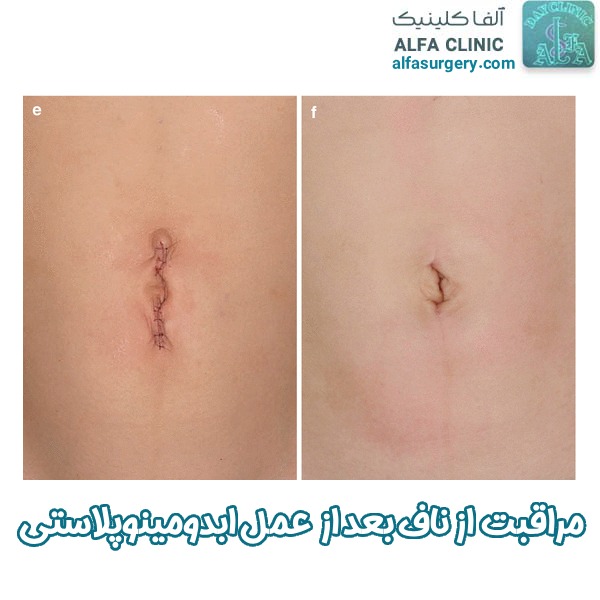 مراقبت از ناف بعد از ابدومینوپلاستی - مرکز جراحی آلفا