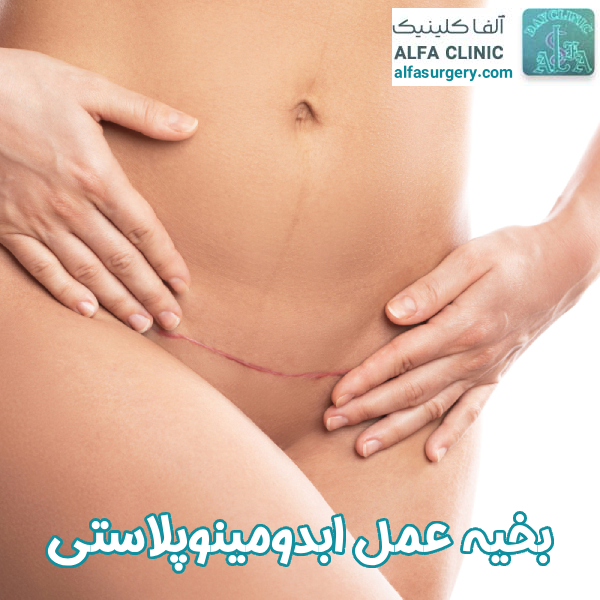 بخیه ابدومینوپلاستی - مرکز جراحی آلفا