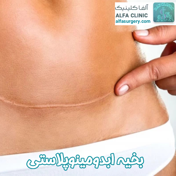 بخیه بعد از ابدومینوپلاستی - مرکز جراحی آلفا