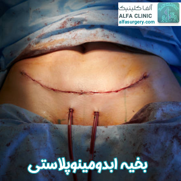 بخیه ابدومینوپلاستی - مرکز جراحی آلفا