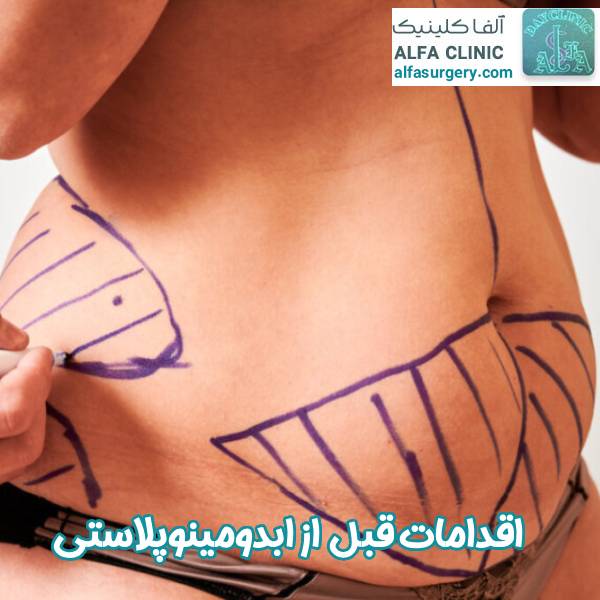 اقدامات قبل از ابدومینوپلاستی - مرکز جراحی آلفا