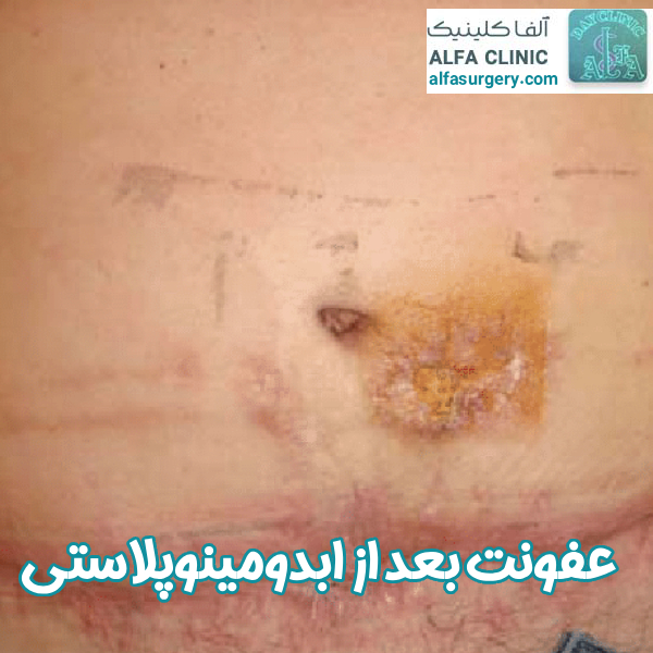 عفونت بعد از عمل ابدومینوپلاستی - مرکز جراحی آلفا