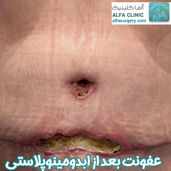 عفونت بعد از عمل ابدومینوپلاستی - مرکز جراحی آلفا 