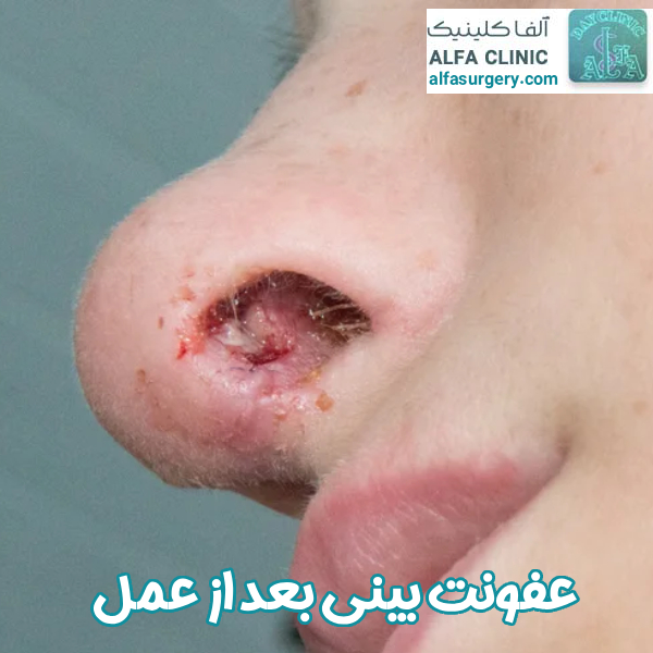 عفونت بینی بعد از عمل - مرکز جراحی الفا
