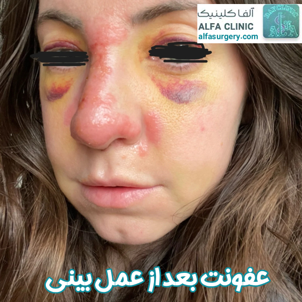 عفونت بینی بعد از عمل - مرکز جراحی الفا