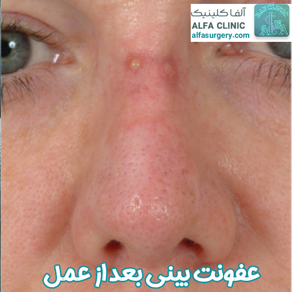 عفونت بعد از عمل بینی - مرکز جراحی الفا