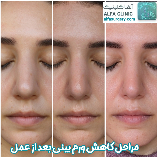 ورم بینی بعد از عمل - مرکز جراحی آلفا