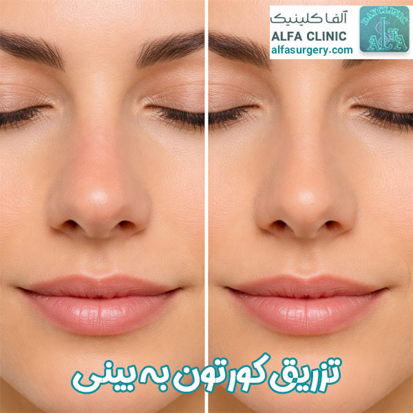 تزریق کورتون به بینی - مرکز جراحی آلفا