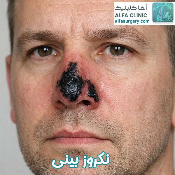 نکروز بینی - مرکز جراحی آلفا