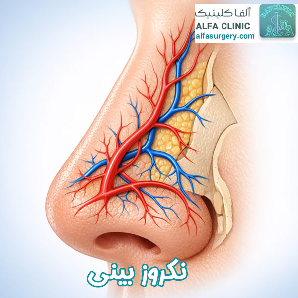 نکروز بینی - مرکز جراحی آلفا