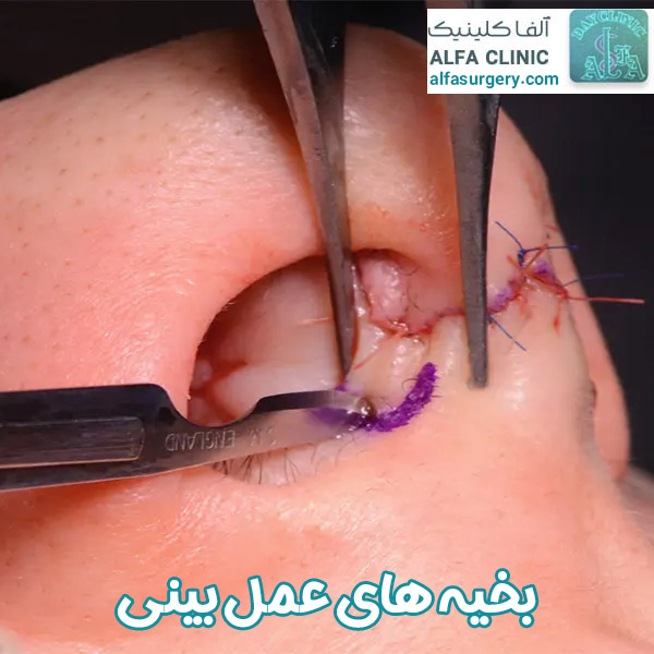 بخیه های عمل بینی - مرکز جراحی آلفا
