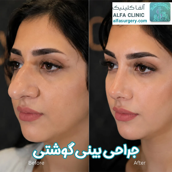 جراحی بینی گوشتی در مرکز جراحی آلفا با بهترین جراحان تهران